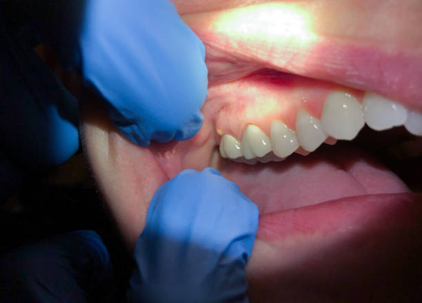Best Emergency Dentist for Lost Fillings or Crowns in Gotha, FL